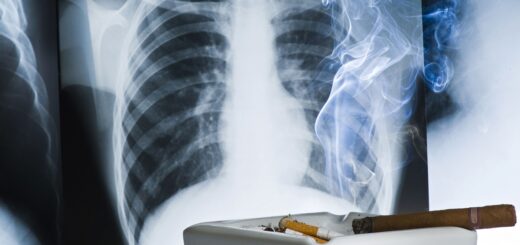 España inicia el primer cribado para la detección precoz del cáncer de pulmón
